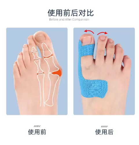 Muscle Tape to the Chest